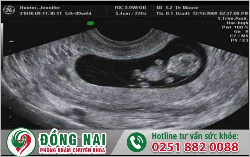 Giải Quyết Thai 9 Tuần Sao Cho An Toàn