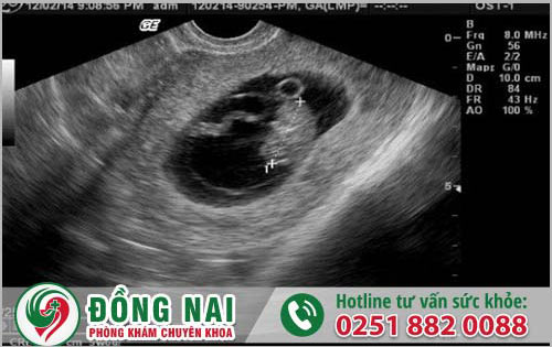 Làm thế nào để có thể nhận biết thai lưu?