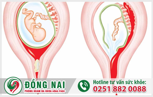 Tự ý phá thai bằng thuốc tại nhà dẫn đến tình trạng sót thai, sót nhau