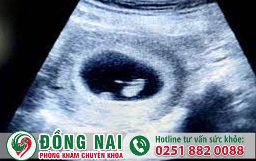 Nên hay không nên bỏ thai 6 tuần tuổi?