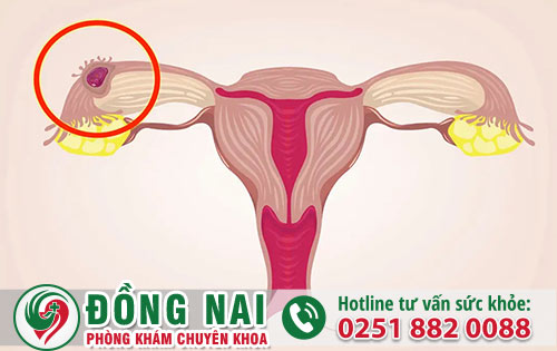 Thai chưa vào tử cung phá được không?